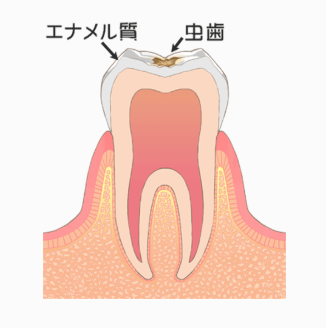 むし歯の段階：C1